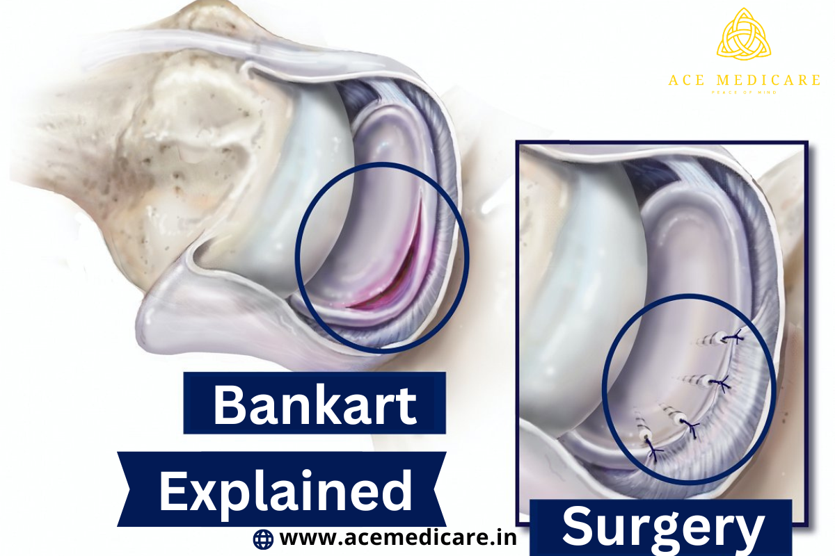 Bankart Surgery Explained: A Comprehensive Overview